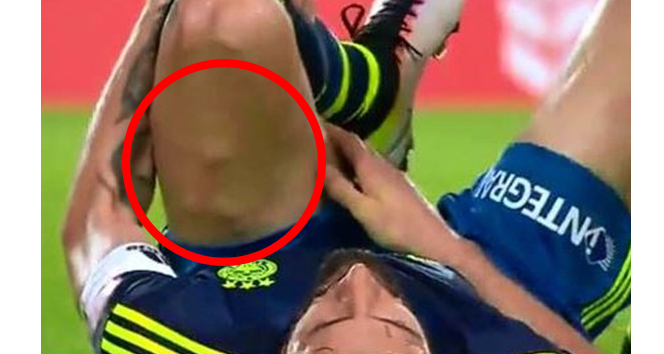 Mehmet Topal&#039;ın bacağındaki şok görüntü