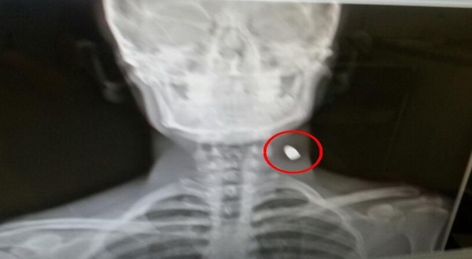X-Ray Cihazı İkaz Verince Boynunda Mermi Olduğu Ortaya Çıktı