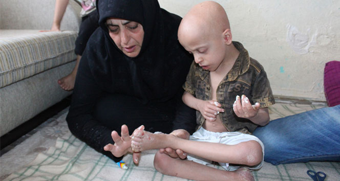 Suriyeli çocuğun iyileşmeyen hastalığı
