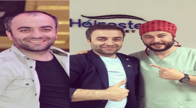 Saç ekiminde ikinci seans şart