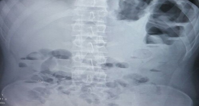 Midesine 1 kilo 37 gram eroin sığdırdı