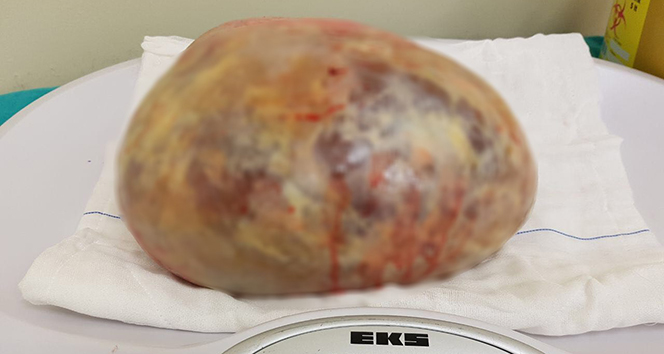 Samsun&#039;da bir hastadan 5 kilo 350 gram kist çıkarıldı