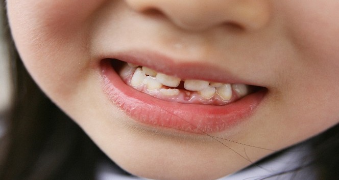 ‘Diş ayrıklığı 16 yaş sonrasında anormal’