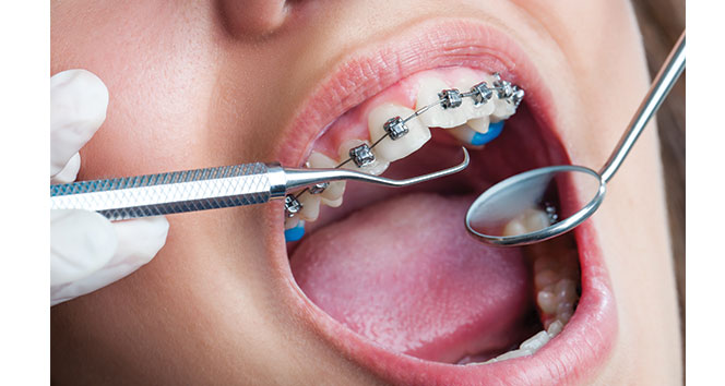 Ortodontik tedavi öncesi dişeti muayenesi şart