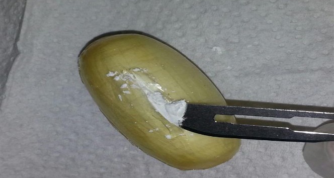 Brezilyalı kuryenin midesinden 59 kapsül kokain çıktı