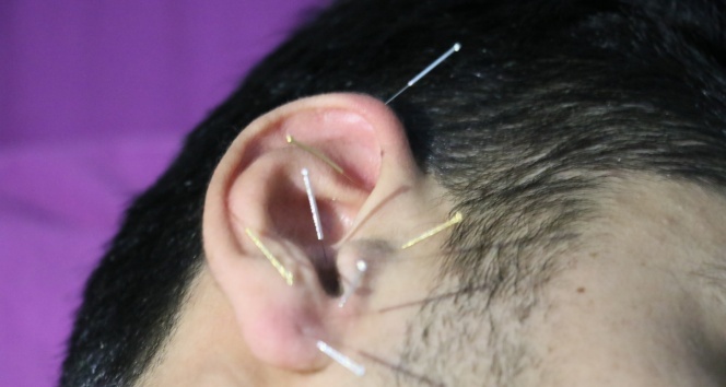 Akupunktur sağlığa zararlı mı? Akapunkturun zararları