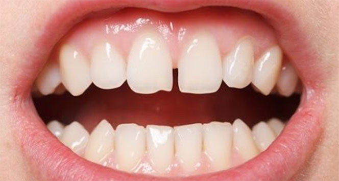 Zirkonyum diş kaplama nedir?  Zirkonyum tedavisi nasıl yapılır? Zirkonyum ile ayrık dişlerinizden kurtulun