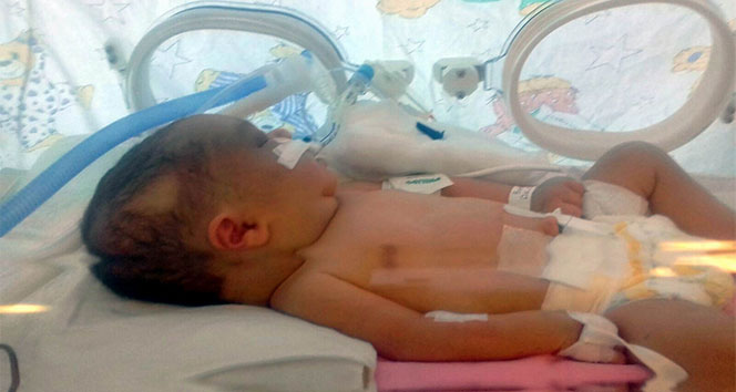 Kafatası çatlayan 6 günlük bebek, yaşam savaşı veriyor