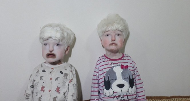 Albino kardeşler yardım bekliyor