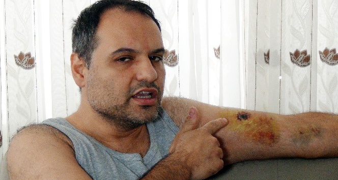 Antalya’da tartıştığı hasta bakıcı tarafından kolundan ısırılan vatandaş hastanelik oldu