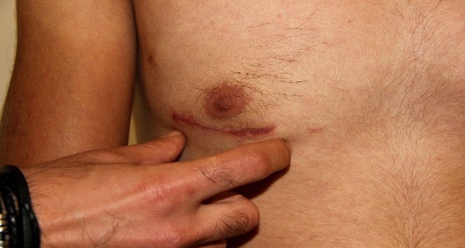 Göğüs kafesi açılmadan delik kalbi ameliyat edildi