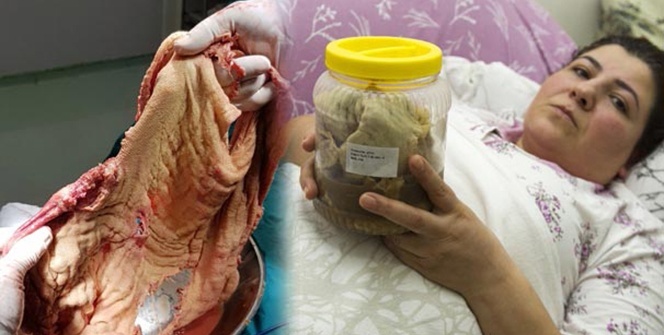 Tam 1.8 kilo! Karnından çıktı