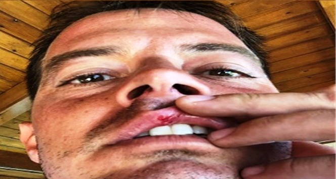 Alp Kırşan tatilde motosikletiyle kaza yaptı