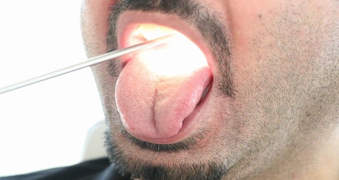 Geçmeyen ağız kokusu, dil kanseri belirtisi olabilir