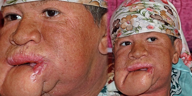 Çenesinde çıkan sivilceyi önemsemedi, hayatı karardı