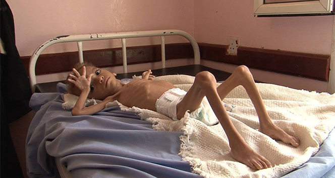 Yemen’de savaşın çocukları açlıkla mücadele ediyor