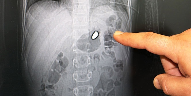 10 yaşındaki çocuğun vücudundan çıkartıldı! Polis hemen harekete geçti