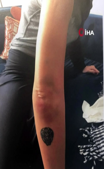 Fotoğraflarda Sıla`nın kollarındaki morluklar görülüyor. 