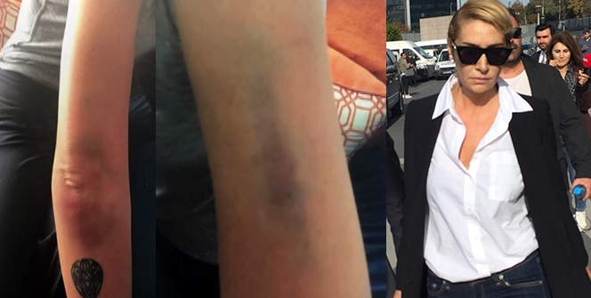 İşte şiddetin fotoğrafı! Ünlü şarkıcının vücudundaki morluklar böyle görüntülendi