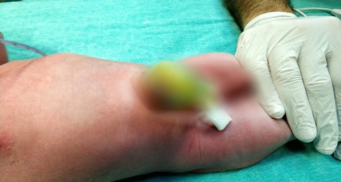 Yaklaşık 2 bin bebekten birinde görülüyor