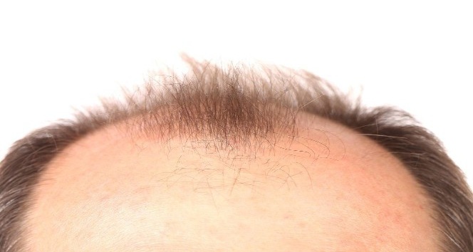 “Kullandığınız ilaçlar saçlarınızın dökülme nedeni olabilir”