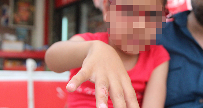 Antalya’da annenin çocuğunun parmağını dağladığı iddiası