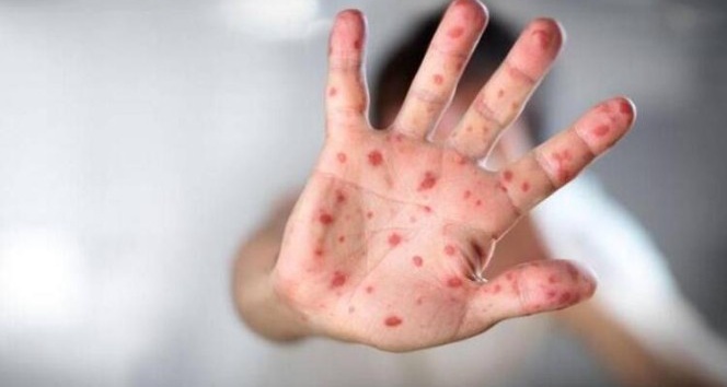 Çocuklarda el, ayak ve ağız hastalığı hastalığına dikkat