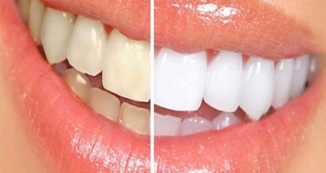 Dişlerde renk değişimine dikkat