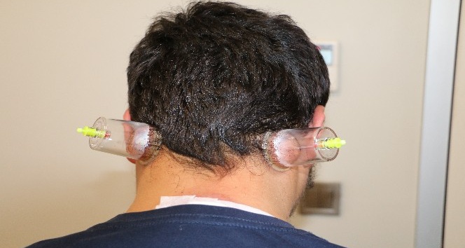 Soğuk hava migrenine hacamat