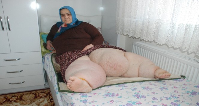 Trafik kazası sonrasında bacakları şişen kadın yaşam savaşı veriyor