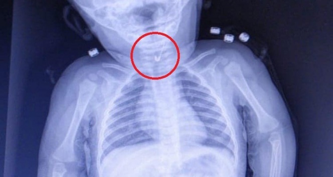 7 aylık bebeğin yemek borusundan çengelli iğne çıktı