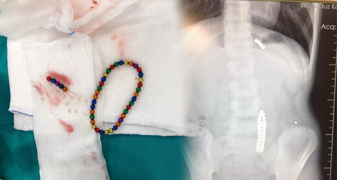 Karın ağrısıyla hastaneye giden çocuğun midesinden 42 adet mıknatıs topu çıktı