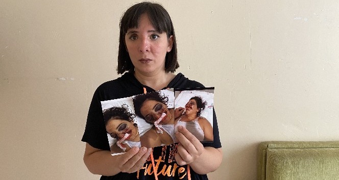 (Özel) ATV kazasında gözünü kaybeden genç kadın adalet bekliyor