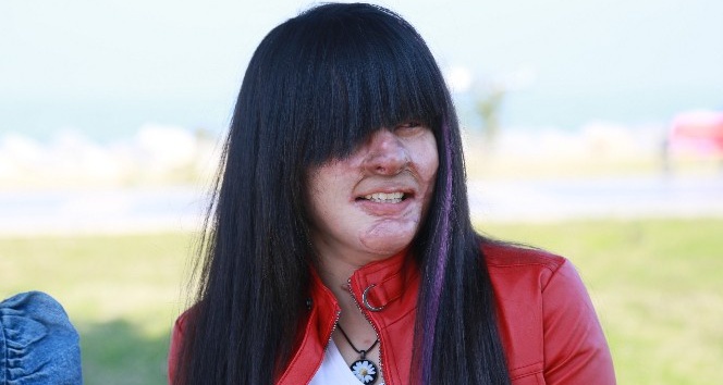 Yüzüne asit döken erkek arkadaşını affeden Berfin: “Bunu nasıl yapabildim”