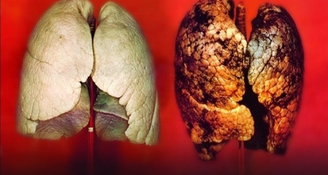 Beta karoten akciğer kanseri riskini arttırıyor