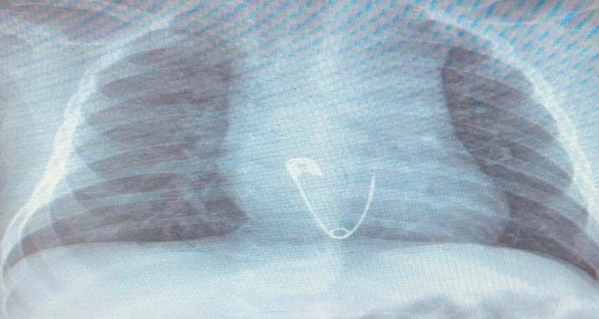 5 aylık bebeğin yuttuğu çengelli iğne operasyonla çıkarıldı