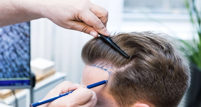 Merdiven altı saç ekimine dikkat