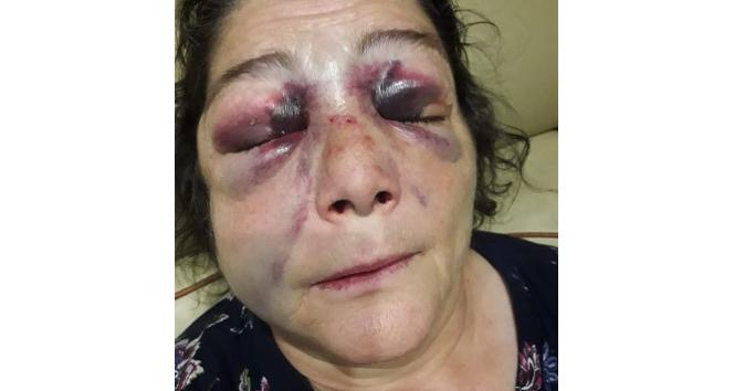 Kadını döverek bu hale getirdiler