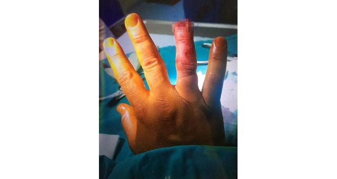 Gece kulübüne alınmayan kadın, güvenlik görevlisinin parmağını kopardı