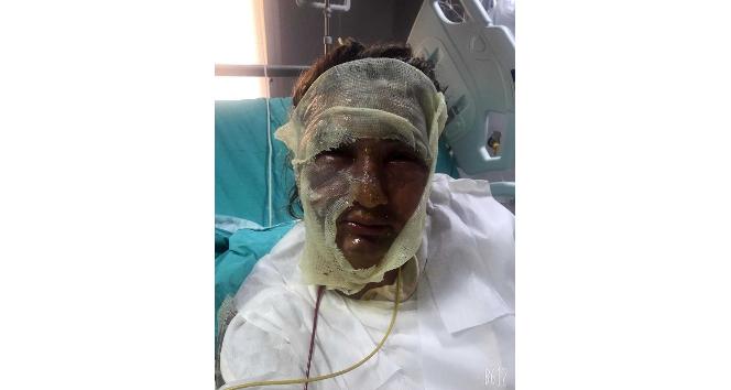 Kız arkadaşının yüzüne kızgın yağ atan Ersin Ülker’in yeniden yargılandığı dava karara bağlandı