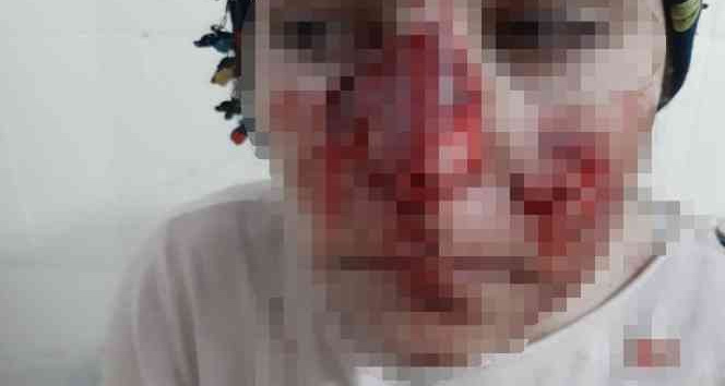 Mardin’de sokak köpeği vahşeti: Vatandaşların yüzleri parçalandı