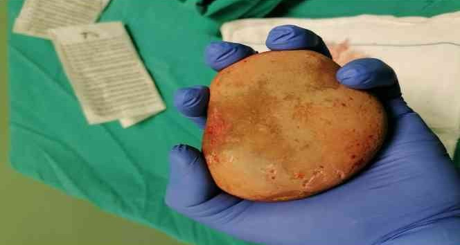 Mesaneden çıkan taş doktorları şaşırttı