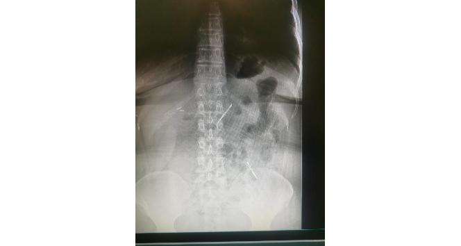 Karın ağrısı şikayetiyle gitti, 2 tane neşter yuttuğunu öğrendi