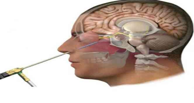 Yalova’da İlk kez Özel Atakent Hastanesi’nde kapalı yöntemle endoskopik hipofiz cerrahisi uygulandı