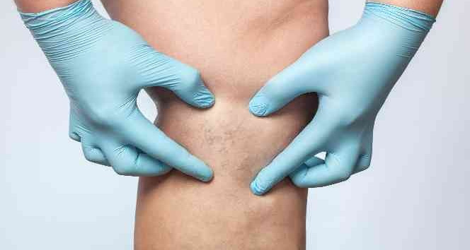 Thermoblock ile kılcal damarlarınızdan anında kurtulun