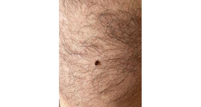 Koluna yapışan keneyi dikiş ipiyle çıkardı