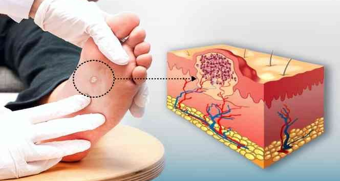 Siğiller kâbusunuz olmasın