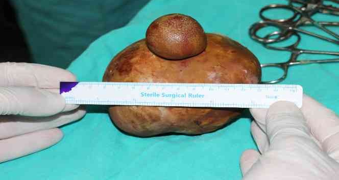 Karaman’da bir hastanın mesanesinden 15x10 ve 4x3 büyüklüğünde 2 taş çıktı