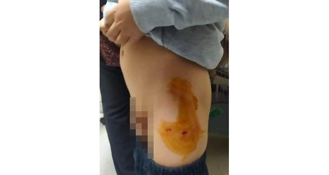 Mardin’de sokak köpeği 6 yaşındaki çocuğu ısırdı