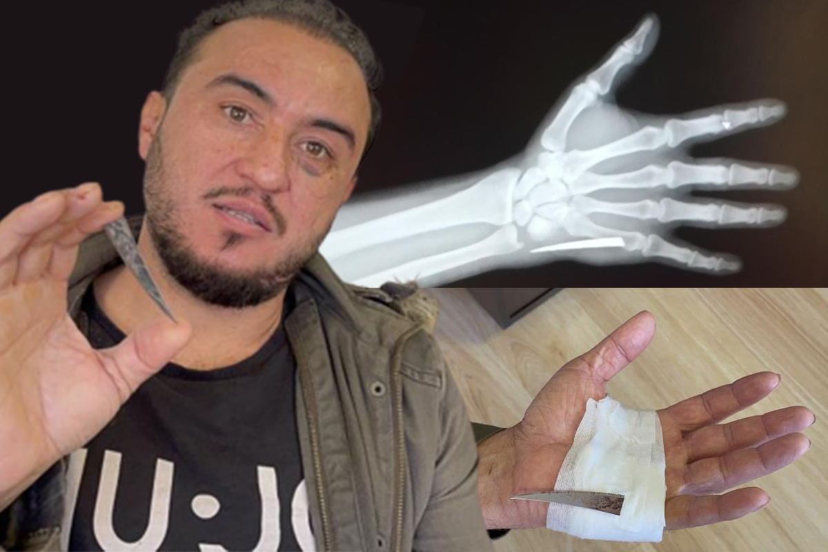 Elinin acısıyla gittiği hastanede çekilen röntgenle hayatının şokunu yaşadı